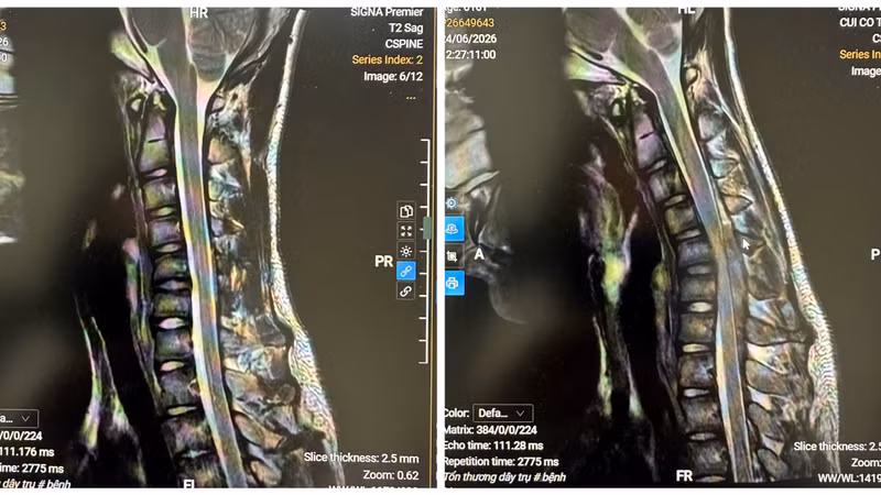 MRI tư thế trung gian và MRI tư thế gập cổ