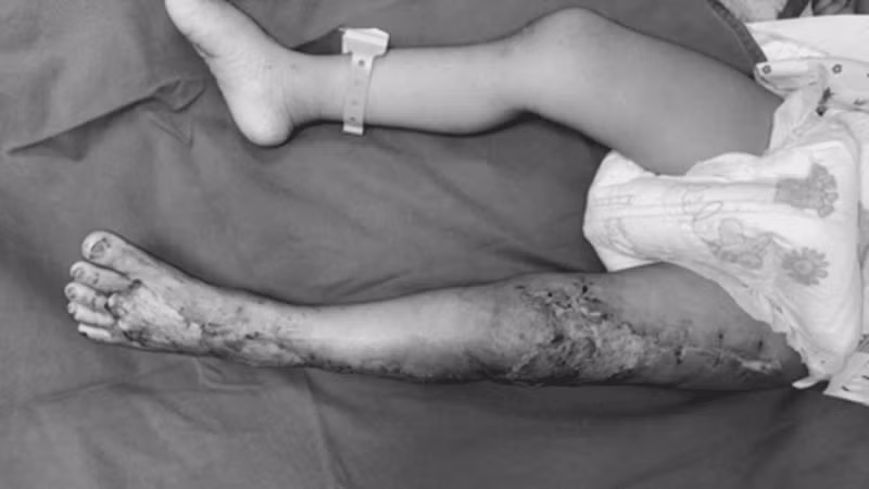 Kỹ thuật ghép da đầu giúp bé trai thoát khỏi cắt bỏ chân sau rắn độc cắn