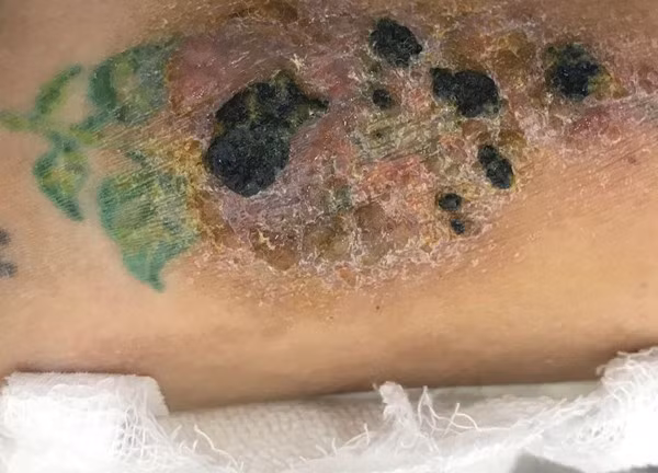 Bác sĩ da liễu cảnh báo trào lưu “họa da” trong giới trẻ