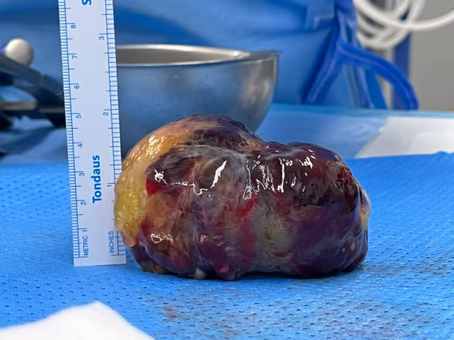 Benh vien Quan y 175: Co gai tre 20 tuoi bi u nhay nhi phai khong lo