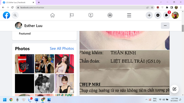 Bác sĩ ĐH Y Dược TP HCM lý giải về căn bệnh liệt mặt mà Hari Won đang mắc phải - Hình 2 Bac si DH Y Duoc TP HCM ly giai ve can benh liet mat ma Hari Won dang mac phai-Hinh-2