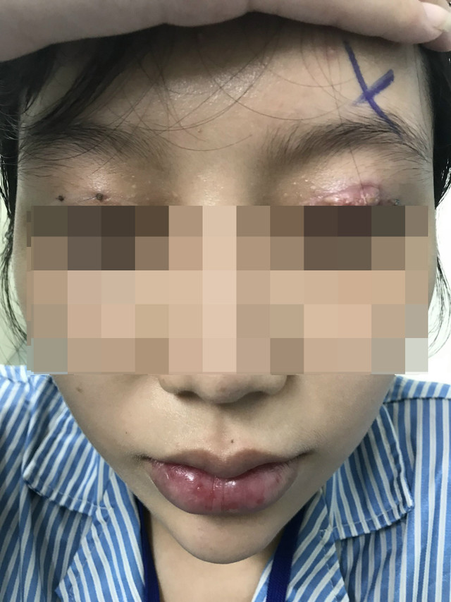 Bệnh viện Mắt TP HCM cấp cứu nhiều ca tổn thương mắt do làm đẹp ở cơ sở chui Benh vien Mat TP HCM cap cuu nhieu ca ton thuong mat do lam dep o co so chui