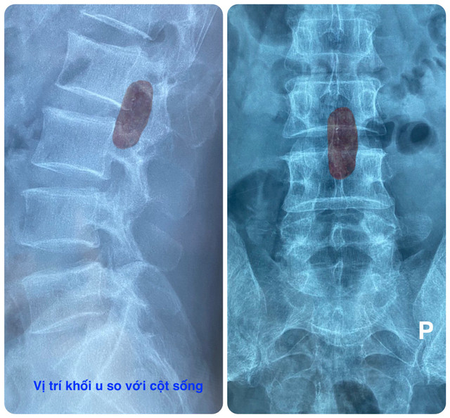 Tưởng đau lưng đơn giản, người đàn ông tự mua thuốc giảm đau cho đến khi bị liệt Tuong dau lung don gian, nguoi dan ong tu mua thuoc giam dau cho den khi bi liet
