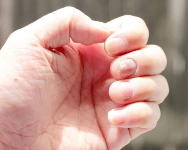 Những dấu hiệu cho thấy gan bạn đang tích lượng độc tố quá mức - Hình 2 Nhung dau hieu cho thay gan ban dang tich luong doc to qua muc-Hinh-2