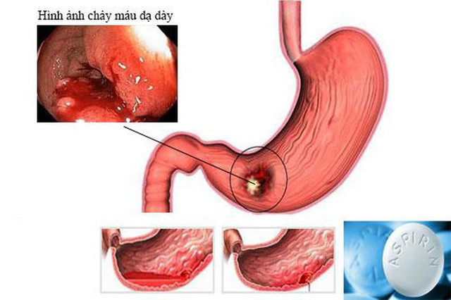 Những loại thuốc hạ sốt không được dùng khi sốt xuất huyết Nhung loai thuoc ha sot khong duoc dung khi sot xuat huyet