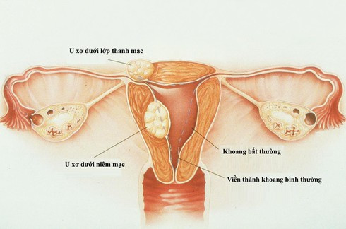 Những vấn đề nguy cấp đáng chú ý khi kinh nguyệt bạn bất thường - Hình 3 Nhung van de nguy cap dang chu y khi kinh nguyet ban bat thuong-Hinh-3