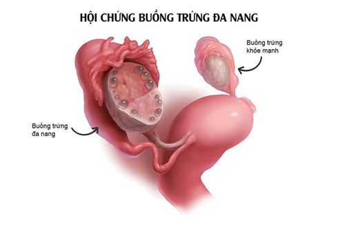 Những vấn đề nguy cấp đáng chú ý khi kinh nguyệt bạn bất thường - Hình 2 Nhung van de nguy cap dang chu y khi kinh nguyet ban bat thuong-Hinh-2