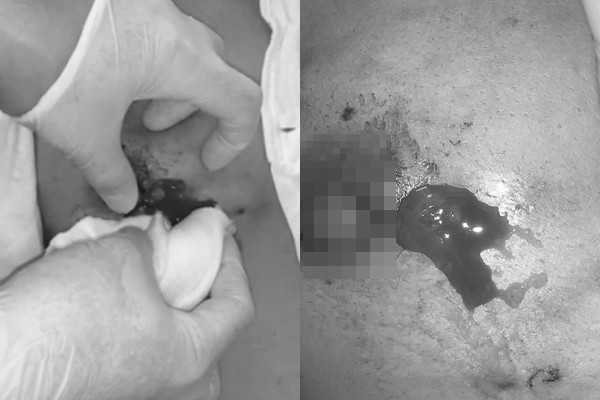 Người phụ nữ nâng cấp vòng 1 thì ngực phình to gấp đôi, chảy mủ Nguoi phu nu nang cap vong 1 thi nguc phinh to gap doi, chay mu