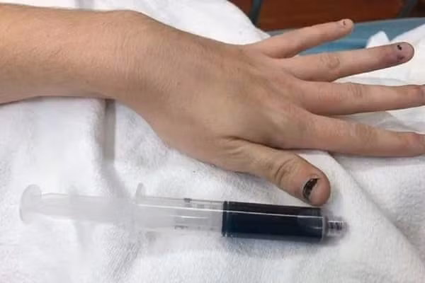 Chuyen hi huu: Sau khi uong thuoc dau rang, mau cua mot co gai chuyen mau xanh