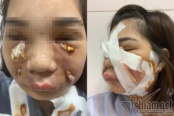 Co gai xinh dep bien dang vi rach mat nan mu vi tu tiem mo-Hinh-2
