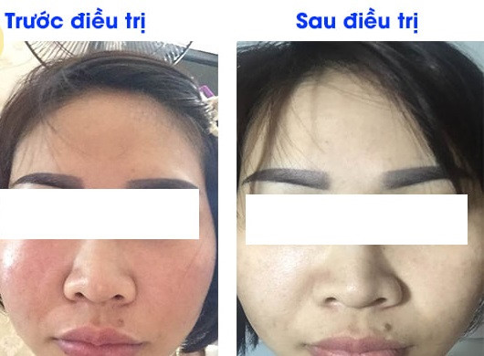 Trị nám ở spa, cô gái đau đớn mang ổ viêm trên mặt Tri nam o spa, co gai dau don mang o viem tren mat