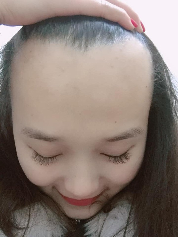 Mà chẳng phải riêng cô nàng này, nhiều chị em cũng tỏ ra mệt mỏi khi thường xuyên phải để tóc mái, kể cả là trong mùa hè nóng bức cũng chỉ nhằm mục đích che giấu chiếc trán dô bất đắc dĩ mà thôi.