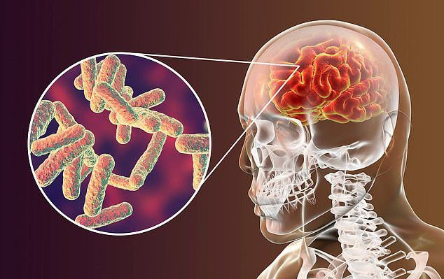 Cô gái bị viêm màng não nặng vì một món cực quen thuộc - Hình 9 Co gai bi viem mang nao nang vi mot mon cuc quen thuoc-Hinh-9