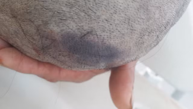 Vết tím trên vùng đầu nạn nhân Thạch.