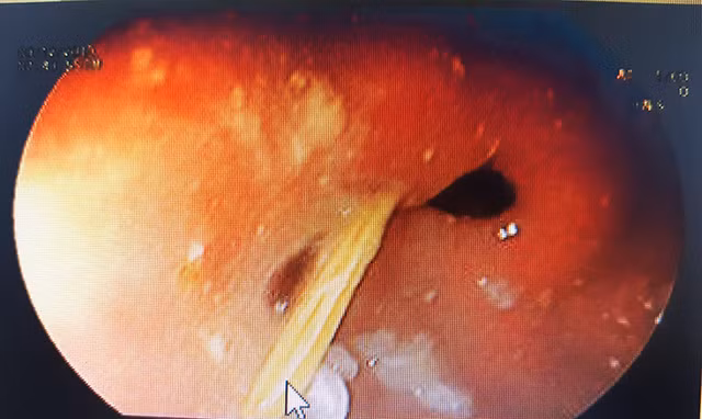 Nam thanh nien bi tam xia rang troi vao bung dam thung da day