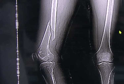 Tập yoga quá độ, thanh niên suýt liệt luôn chân Tap yoga qua do, thanh nien suyt liet luon chan