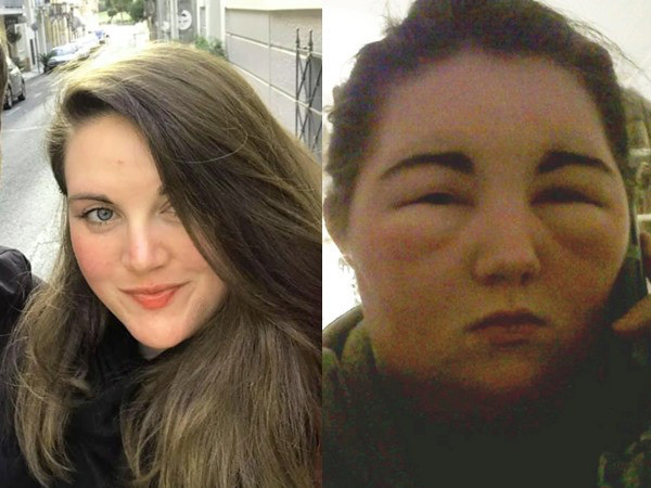 Liên tục nhuộm tóc, cô gái phải trả cái giá quá đắt Lien tuc nhuom toc, co gai phai tra cai gia qua dat