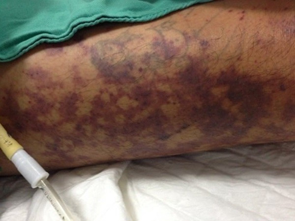 Chọn thịt lợn thế nào để tránh mắc viêm màng não do liên cầu khuẩn lợn Chon thit lon the nao de tranh mac viem mang nao do lien cau khuan lon