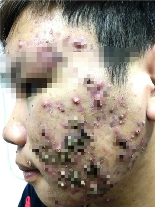 Phát hoảng những khuôn mặt biến dạng vì thuốc trị mụn mua trên mạng - Hình 2 Phat hoang nhung khuon mat bien dang vi thuoc tri mun mua tren mang-Hinh-2