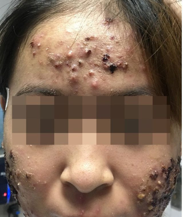 Phát hoảng những khuôn mặt biến dạng vì thuốc trị mụn mua trên mạng - Hình 3 Phat hoang nhung khuon mat bien dang vi thuoc tri mun mua tren mang-Hinh-3