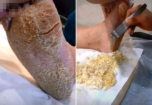 Hoảng hồn với bàn chân như “người đất” Hoang hon voi ban chan nhu “nguoi dat”