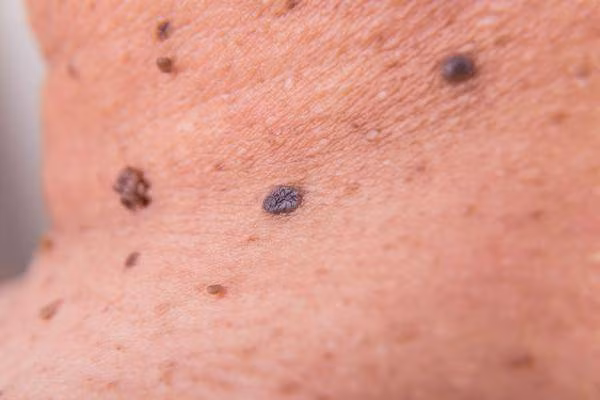 4 dac diem bat thuong cua not ruoi can di kham ung thu ngay-Hinh-3