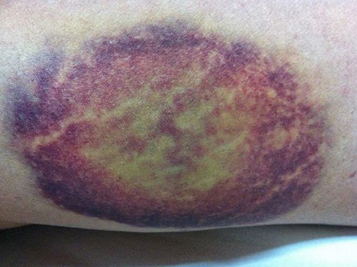 Vết bầm quanh rốn cảnh báo ung thư gan giai đoạn cuối - Hình 11 Vet bam quanh ron canh bao ung thu gan giai doan cuoi-Hinh-11