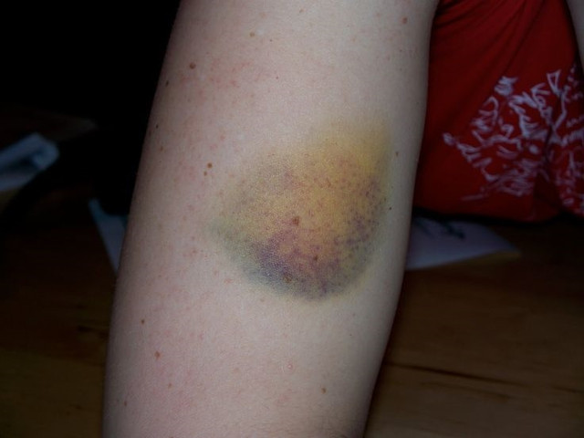 Vết bầm quanh rốn cảnh báo ung thư gan giai đoạn cuối - Hình 7 Vet bam quanh ron canh bao ung thu gan giai doan cuoi-Hinh-7