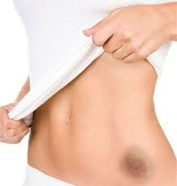 Vết bầm quanh rốn cảnh báo ung thư gan giai đoạn cuối - Hình 3 Vet bam quanh ron canh bao ung thu gan giai doan cuoi-Hinh-3