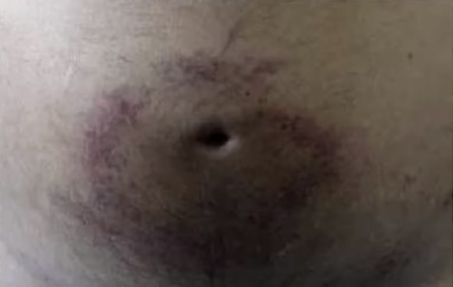 Vết bầm quanh rốn cảnh báo ung thư gan giai đoạn cuối - Hình 9 Vet bam quanh ron canh bao ung thu gan giai doan cuoi-Hinh-9