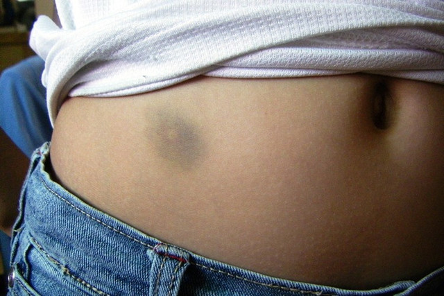 Vet bam quanh ron canh bao ung thu gan giai doan cuoi