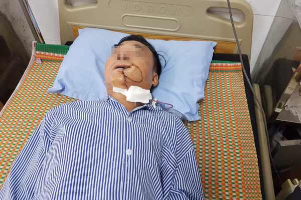 Nhung nguoi de bi ung thu mieng ghe tham