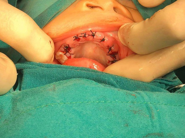 Các mẹ cần lưu ý gì khi bé 4 tuổi bị thối 20 răng sữa? Cac me can luu y gi khi be 4 tuoi bi thoi 20 rang sua?