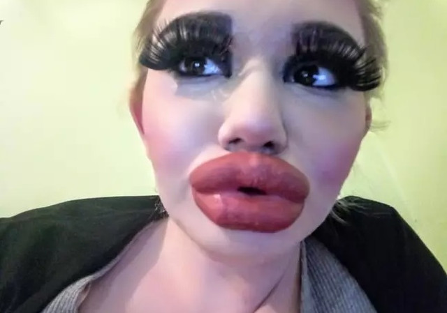 Hoảng hốt nhìn đôi môi biến chứng sau 17 lần làm đẹp - Hình 2 Hoang hot nhin doi moi bien chung sau 17 lan lam dep-Hinh-2