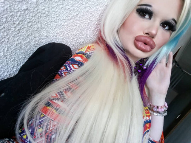 Hoảng hốt nhìn đôi môi biến chứng sau 17 lần làm đẹp Hoang hot nhin doi moi bien chung sau 17 lan lam dep