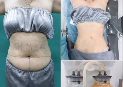 Cẩn trọng với cách làm đẹp tiềm ẩn nguy hiểm như trường hợp nâng ngực ở Thẩm mỹ viện QT Thúy Anh - Hình 2 Can trong voi cach lam dep tiem an nguy hiem nhu truong hop nang nguc o Tham my vien QT Thuy Anh-Hinh-2