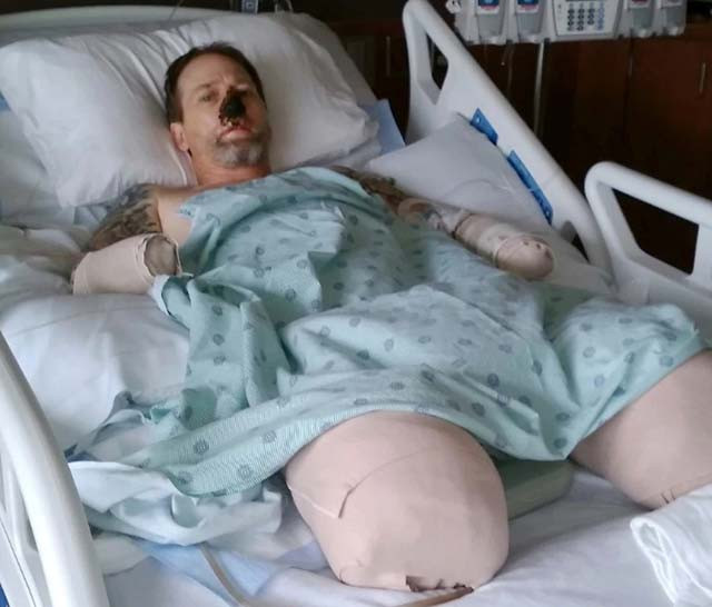 Rùng rợn những trường hợp phải cắt tứ chi chỉ vì vết chó liếm Rung ron nhung truong hop phai cat tu chi chi vi vet cho liem