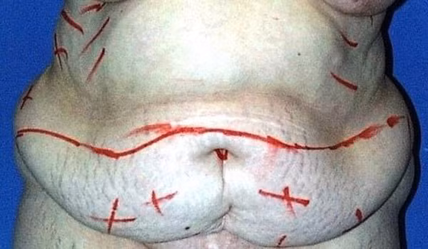 Ba me beo phi duoc phau thuat cat 7kg da, mo thua-Hinh-2