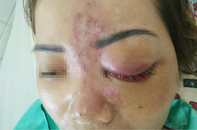 Kinh hoàng những vụ spa không phép tiêm filler gây biến chứng, tàn phế suốt đời - Hình 3 Kinh hoang nhung vu spa khong phep tiem filler gay bien chung, tan phe suot doi-Hinh-3
