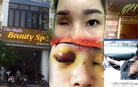 Kinh hoàng những vụ spa không phép tiêm filler gây biến chứng, tàn phế suốt đời Kinh hoang nhung vu spa khong phep tiem filler gay bien chung, tan phe suot doi