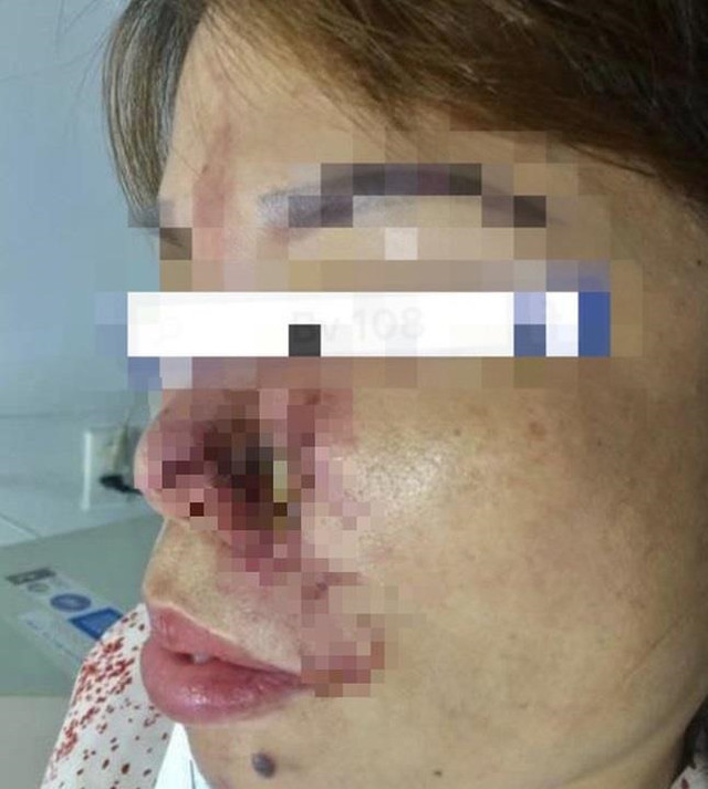 Kinh hoàng những vụ spa không phép tiêm filler gây biến chứng, tàn phế suốt đời - Hình 2 Kinh hoang nhung vu spa khong phep tiem filler gay bien chung, tan phe suot doi-Hinh-2
