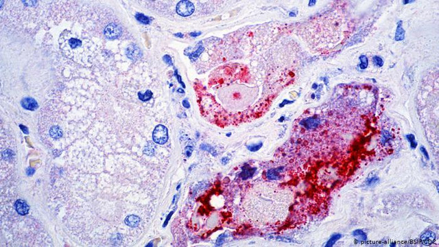 Virus Nipah bùng phát, tỷ lệ tử vong tới 75% - Hình 7 Virus Nipah bung phat, ty le tu vong toi 75%-Hinh-7