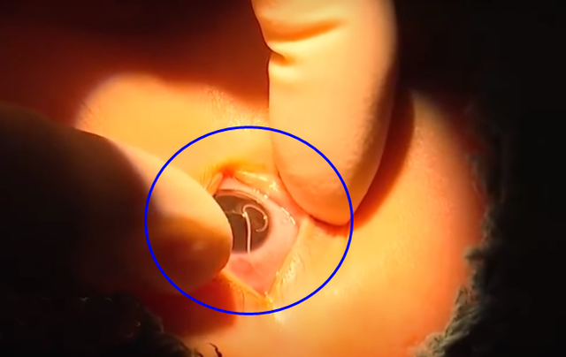 Gần gũi chó cưng, bé trai bị ký sinh trùng làm tổ trong mắt Gan gui cho cung, be trai bi ky sinh trung lam to trong mat