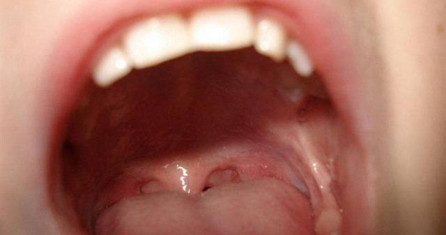 Ung thư lưỡi mà tưởng bị sỏi amidan Ung thu luoi ma tuong bi soi amidan