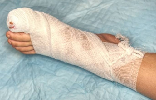 Người đàn ông suýt cụt chi do lạm dụng kháng sinh Nguoi dan ong suyt cut chi do lam dung khang sinh