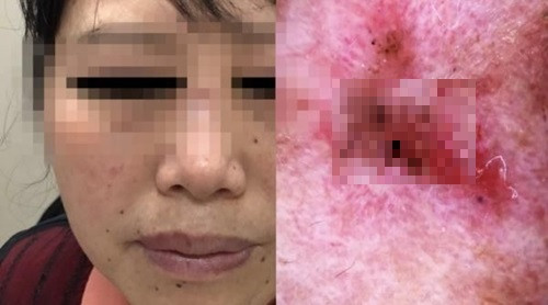 Phát hiện ung thư từ những nốt ruồi trên mặt Phat hien ung thu tu nhung not ruoi tren mat