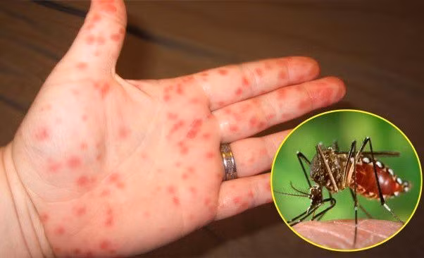 Phong benh sot xuat huyet nhu the nao?