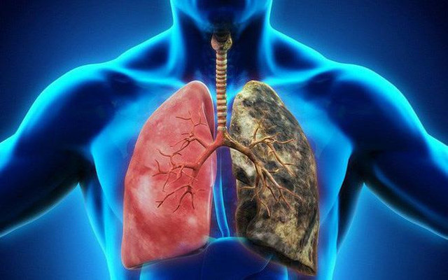 Ung thư và những hiểu biết sai lầm mà nhiều người đang mắc phải - Hình 5 Ung thu va nhung hieu biet sai lam ma nhieu nguoi dang mac phai-Hinh-5