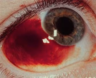 Canh bao sot xuat huyet co the gay tu vong nhu co gai Da Nang-Hinh-9