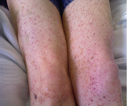 Cảnh báo sốt xuất huyết có thể gây tử vong như cô gái Đà Nẵng - Hình 5 Canh bao sot xuat huyet co the gay tu vong nhu co gai Da Nang-Hinh-5